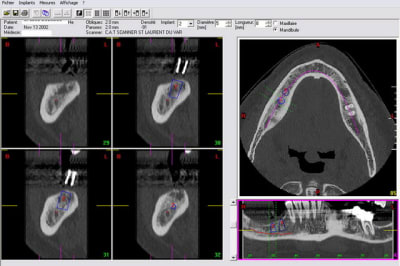 Implant8mmx5mm copie khyy3o - Eugenol