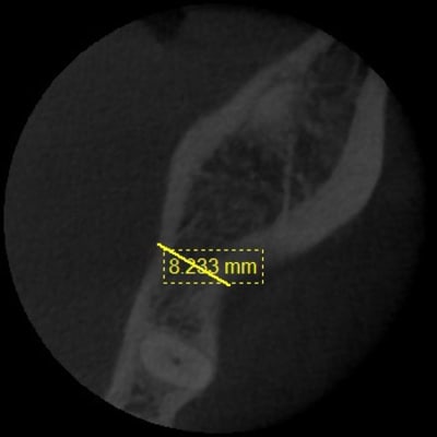 Implant 36 vestibulo lingual   2mm uyvgs1 - Eugenol