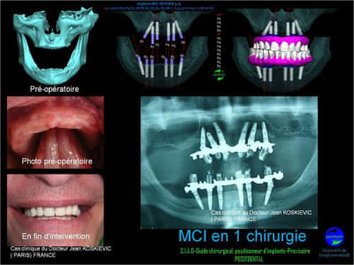 Implant dentaire  mise en charge imm diate    guide chirugical positionneur   positdental 013 rpclds - Eugenol