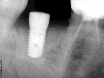Implant edxqcd - Eugenol