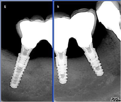 Implant etroit diqe4b - Eugenol
