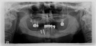 Implant h6jvda - Eugenol