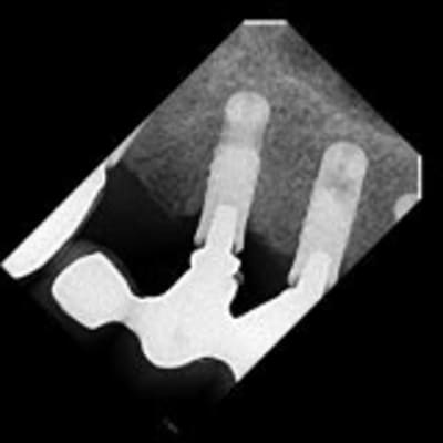 Implant inconnu dwcfib - Eugenol