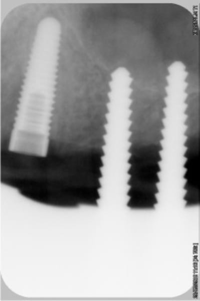 Implant lisse 23 speader c 24 et b 25 mrlas9 - Eugenol