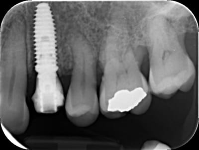 Implant ubbypn - Eugenol