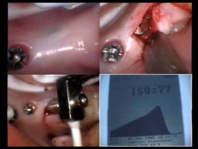 Implants aurélia 02 04 2005 position 46 woah woah woah shb1fc - Eugenol