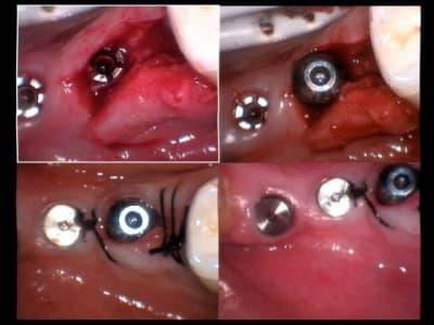 Implants aurélia 02 04 2005 sutures ngovrx - Eugenol