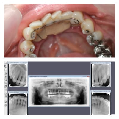 Initial eivnig - Eugenol