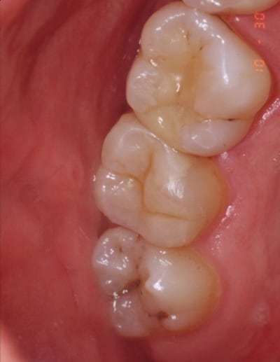 Inlay 2 cpn0vo - Eugenol