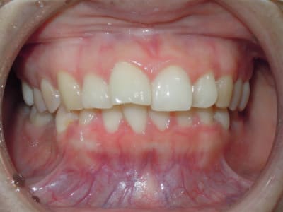 Intra oral frontal msmsq6 - Eugenol