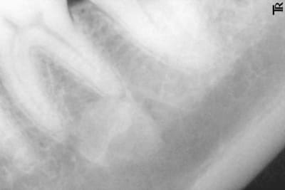 Lésion apicale1 bxarcl - Eugenol