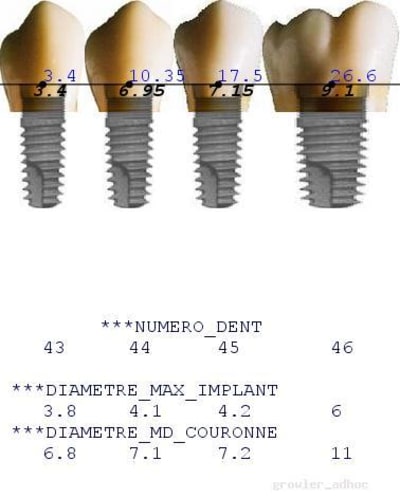 La calculette implantaire pr78ds - Eugenol