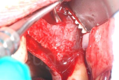 Lift gauche sjmicw - Eugenol