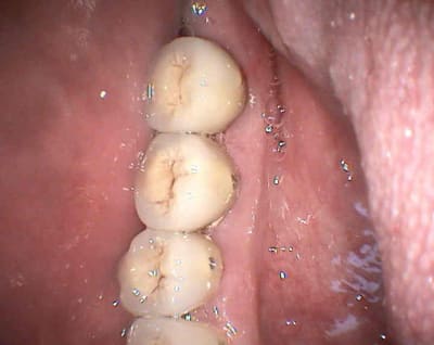 Linguale mbjnnq - Eugenol