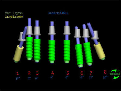 Mandibule 2 dvp5ug - Eugenol