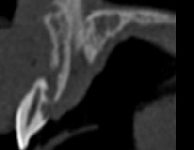 Matribone izmtxp - Eugenol