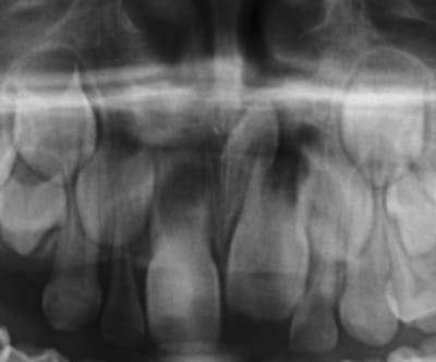 Mesio2 udln8k - Eugenol