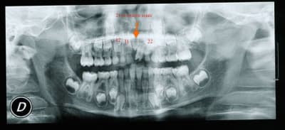 Mesiodens mowars - Eugenol