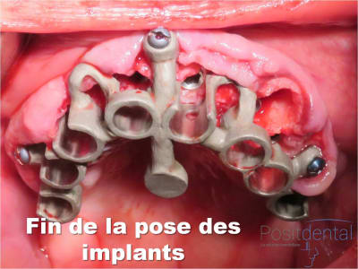 Mise en charge immédiate   implant tov  positdental 012 wkh9li - Eugenol