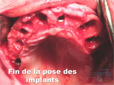 Mise en charge immédiate   implant tov  positdental 013 vjbgtx - Eugenol