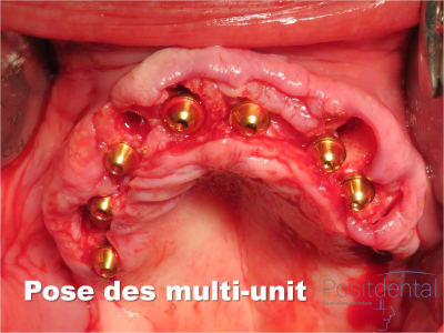 Mise en charge immédiate   implant tov  positdental 014 nvigua - Eugenol