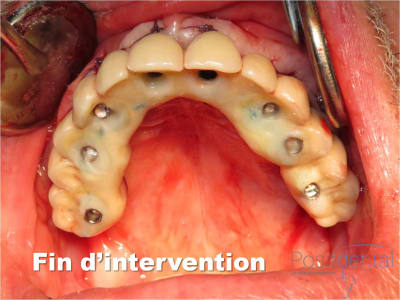 Mise en charge immédiate   implant tov  positdental 024 wkbeiw - Eugenol