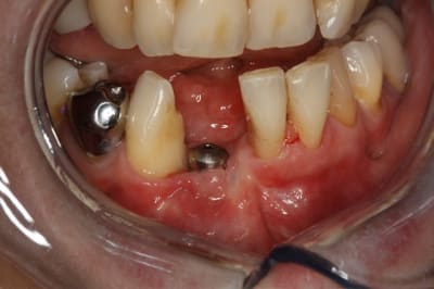 Mise en fonction apr s d pose des sutures un6vqx - Eugenol