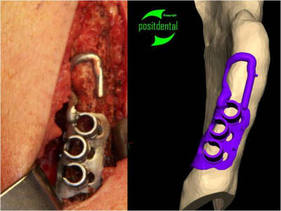 Mod le 3d st rile guide de d coupe 2 uboiei - Eugenol
