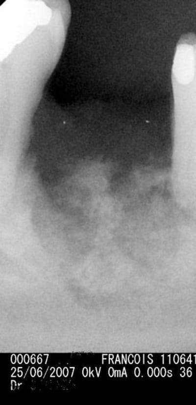 Nécrose vyssnu - Eugenol