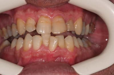 Occlusion coaswq - Eugenol