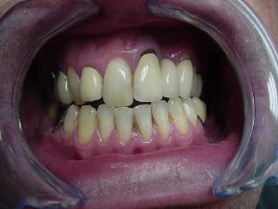 Occlusion mamdqo - Eugenol