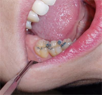 Occlusion uiieaf - Eugenol