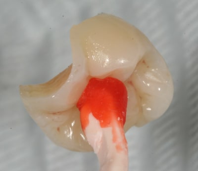 Onlay080 mvom5l - Eugenol