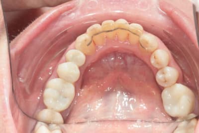 Ortho fin 2 jephx3 - Eugenol