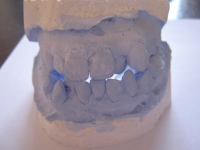 Orthodontie hanguag siham debut de traitement 003 dmi3q4 - Eugenol