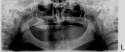 Ossification xsrwws - Eugenol