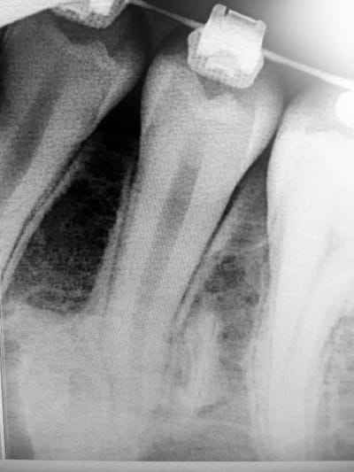 Osteocondensation2 dl0daa - Eugenol