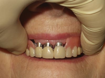 Overdenture xrsnx6 - Eugenol