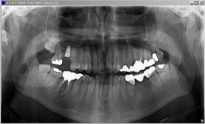 Pano post op maugof - Eugenol