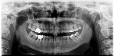 Pano ladyve - Eugenol
