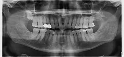 Pano nsdpmi - Eugenol