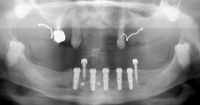 Pano post op o2fbwq - Eugenol