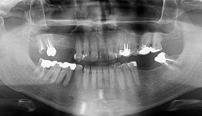 Pano sinus zr70hf - Eugenol