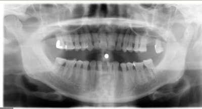 Panorex1 bmeniz - Eugenol