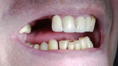 Pap tnjlss - Eugenol