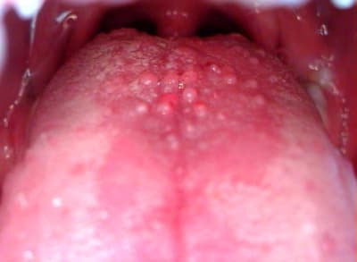 Papille izszxg - Eugenol
