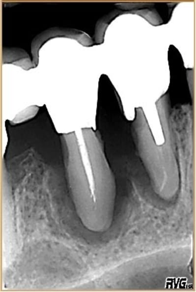 Paro bridge xaaear - Eugenol
