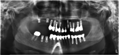 Patiente 1 x5iwwv - Eugenol