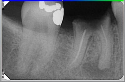 Patiente y btg3qg - Eugenol