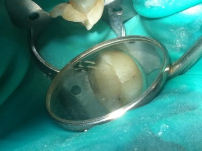 Photo 4 debtyl - Eugenol